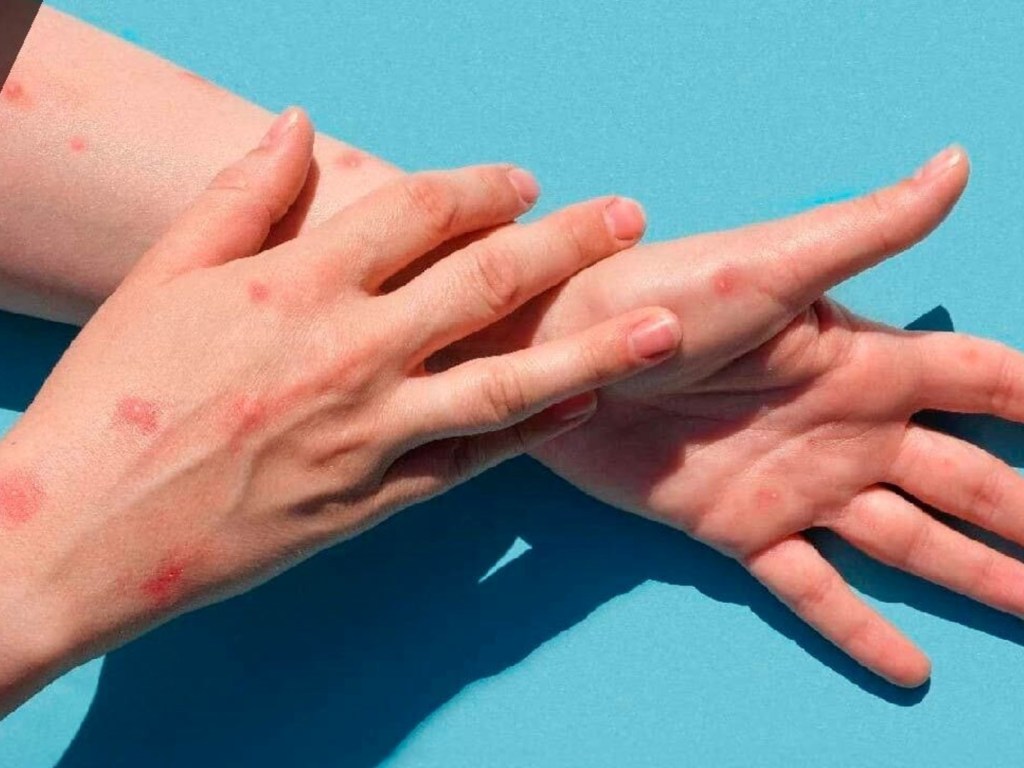 La infección se resuelve por sí sola sin necesidad de tratamiento específico